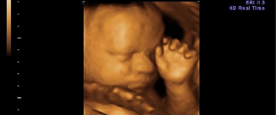 Mensch von Anfang an. Ein Richter in Kentucky versucht dem Obersten Gerichtshof und der Wissenschaft zu trotzen, damit weiterhin ungeborene Kinder getötet werden können.