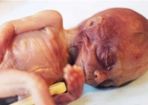 Abtreibung: ein durch Salzsäure verätztes ungeborenes Kind